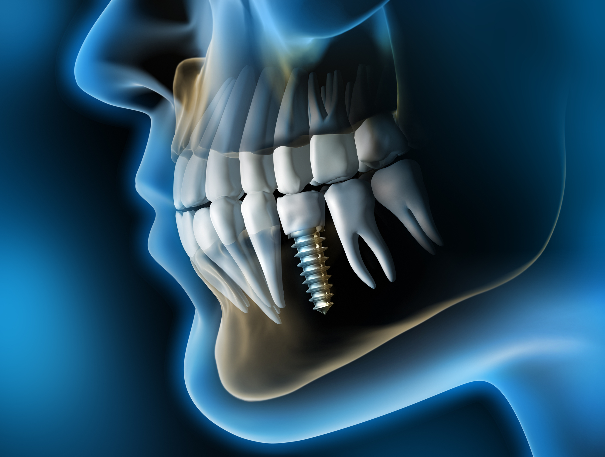 implantes dentales Segovia